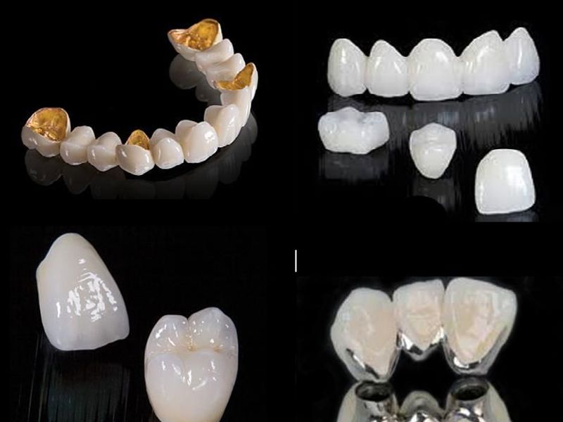 Răng sứ Titan có 3 loại chính Titan Vita (Đức), Titan Margin (Đức – Mỹ) và Titan Berlin
