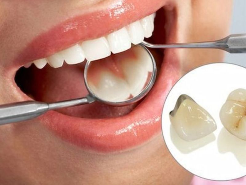 Nhược điểm của răng sứ Titan