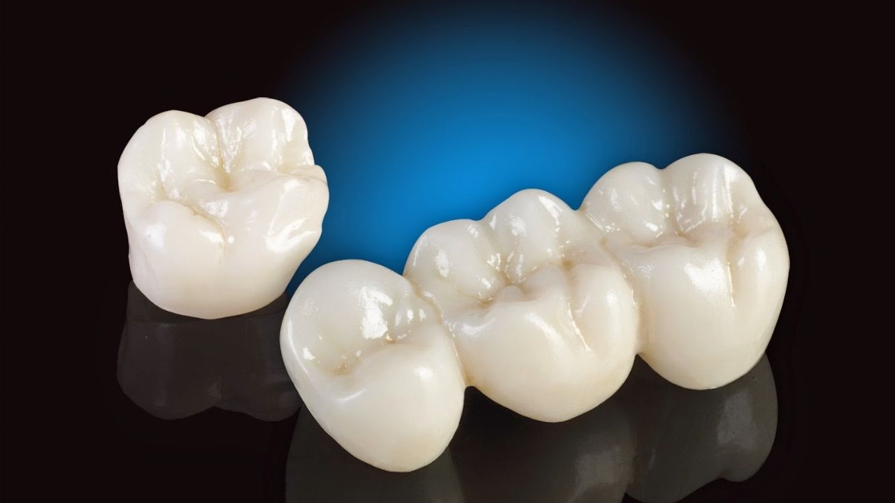 Răng sứ Titan có mấy loại? Bọc loại nào tốt và đẹp nhất ?