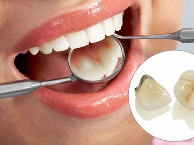 Răng sứ Titan phù hợp với người có tình trạng răng sâu, sứt mẻ, răng thưa, xỉn màu hay bị nứt vỡ