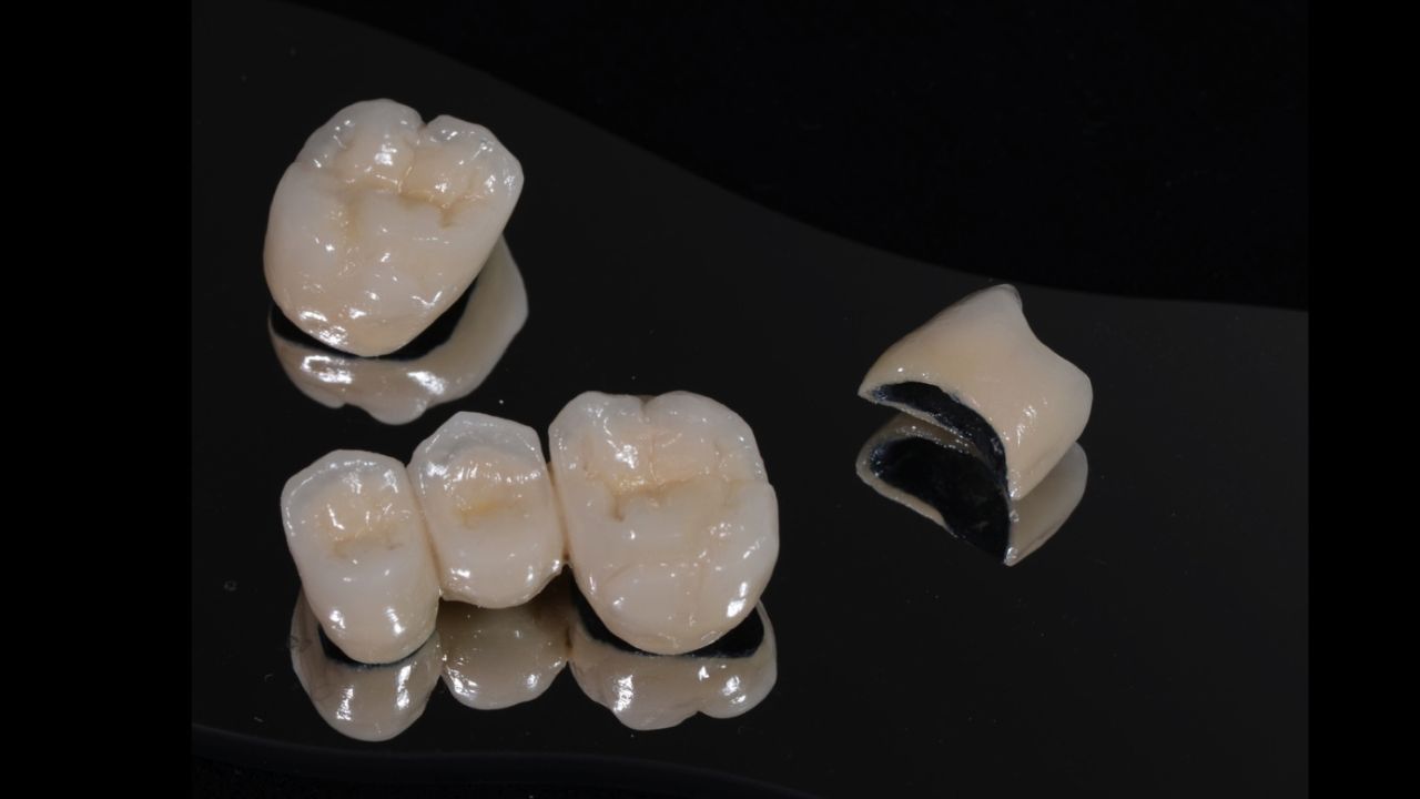 Răng sứ Titan có tốt không? Ưu và nhược điểm