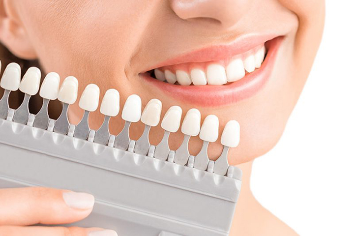 Cách khắc phục răng sứ trắng đục