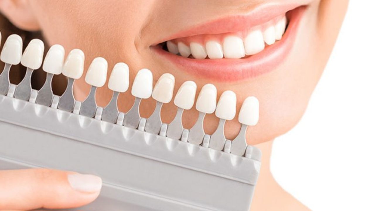 Răng sứ trắng đục: Nguyên nhân và cách khắc phục hiệu quả