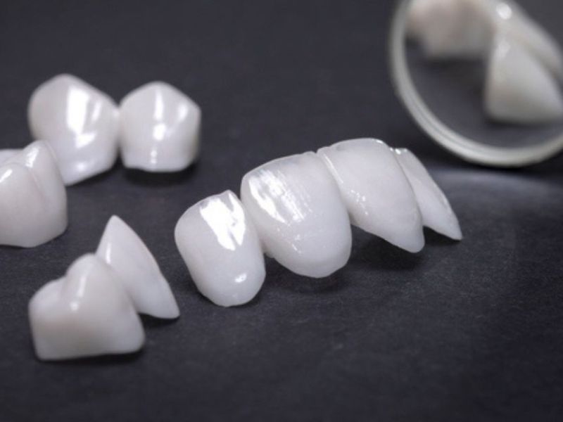 Răng sứ Venus có 6 loại: Venus Classic, Venus Emax, Venus Multi, Venus HT, Venus Pearl và Venus Diamond