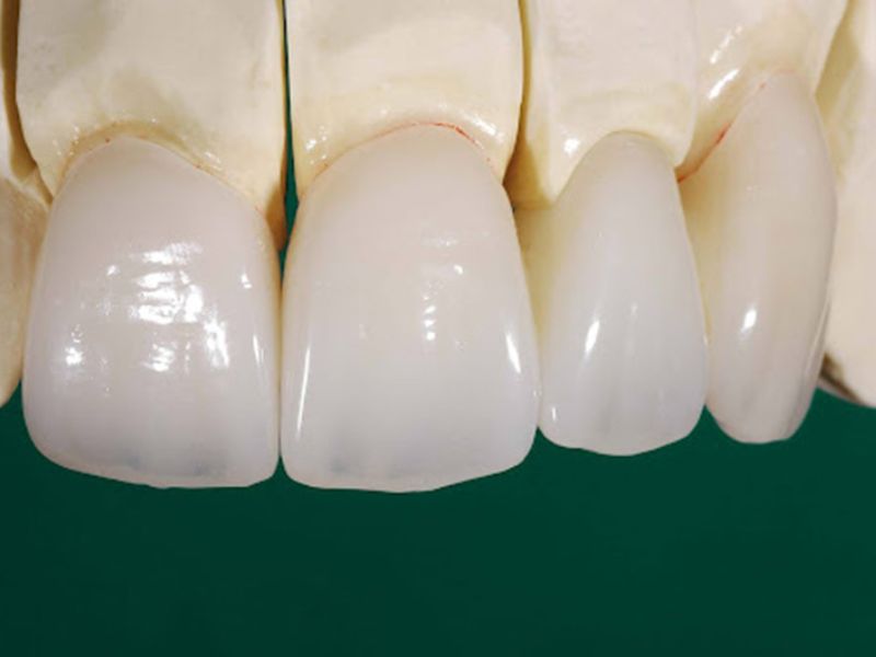 Răng sứ Venus tốt, có độ bền cao chịu lực gấp 4-5  lần răng thật