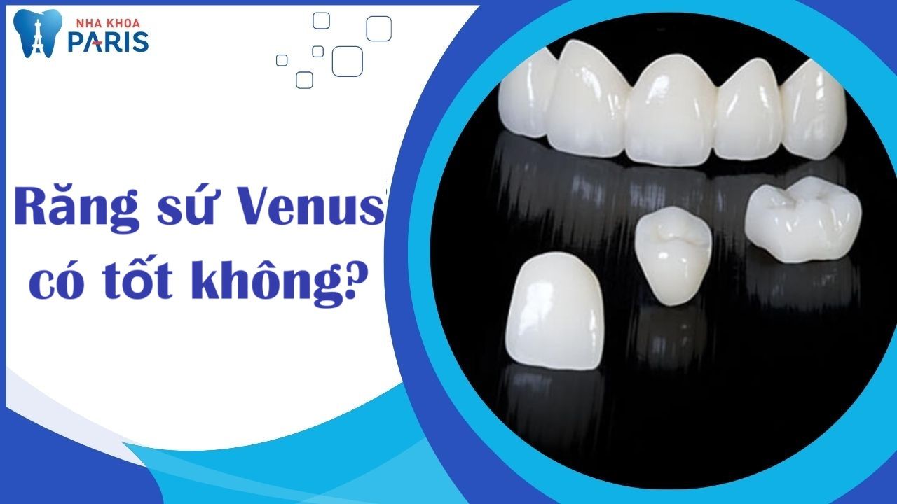 Răng sứ Venus có tốt không? Ưu điểm nổi trội của răng sứ Venus