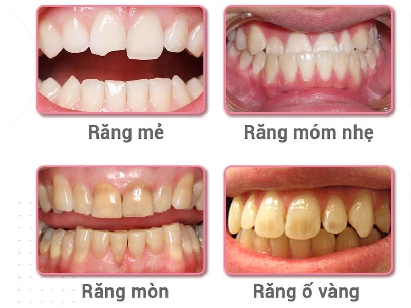 Răng sứ Venus phù hợp cho các trường hợp răng ố vàng, mòn men, thưa hoặc răng nhẹ mẻ, sâu nhẹ