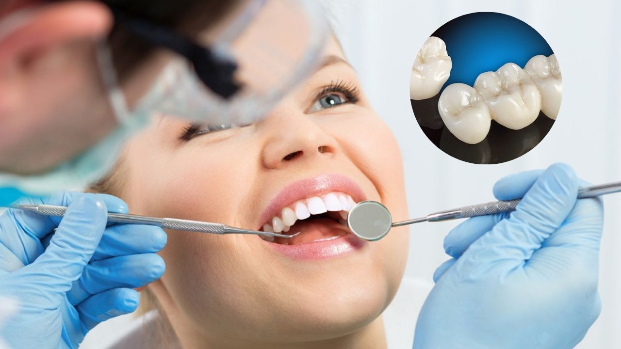 Răng sứ Vita có tốt không? Cần chú ý điều gì