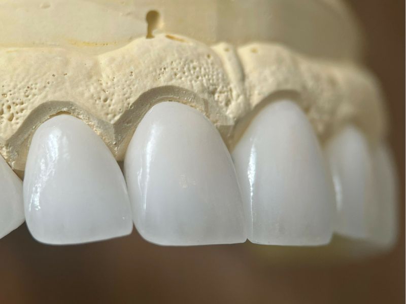 Răng toàn sứ Cercon là dòng zirconia cao cấp của Đức
