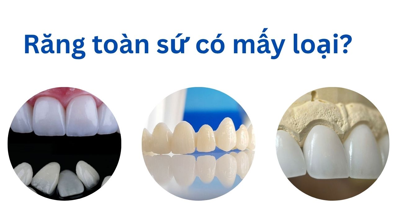 Răng toàn sứ có mấy loại? So sánh các loại răng sứ phổ biến