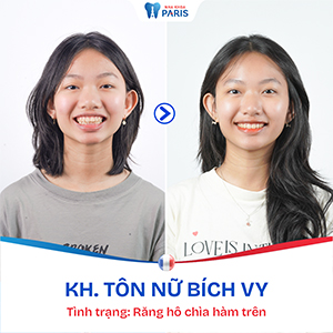 Niềng răng giá tốt