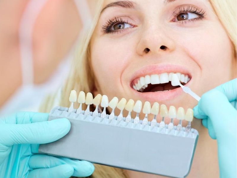 Dán răng sứ ( dán răng sứ Veneer)