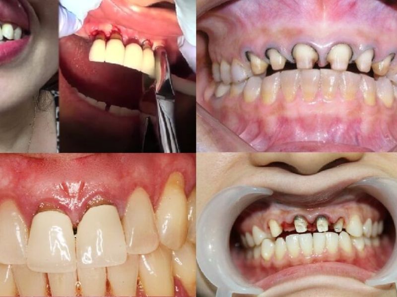 Các tác hại của dán răng sứ thường gặp