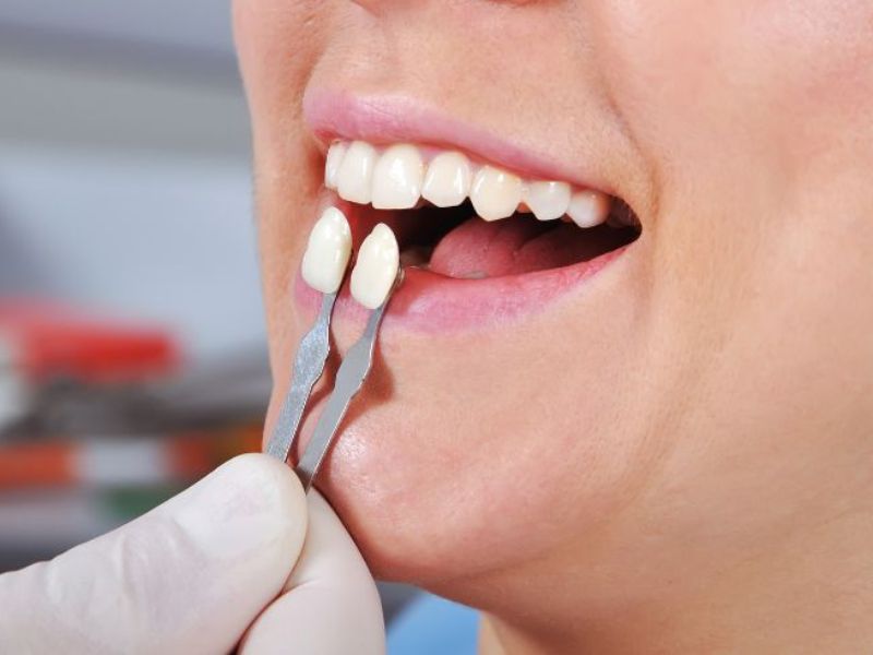 Các trường hợp không nên dán răng sứ Venner