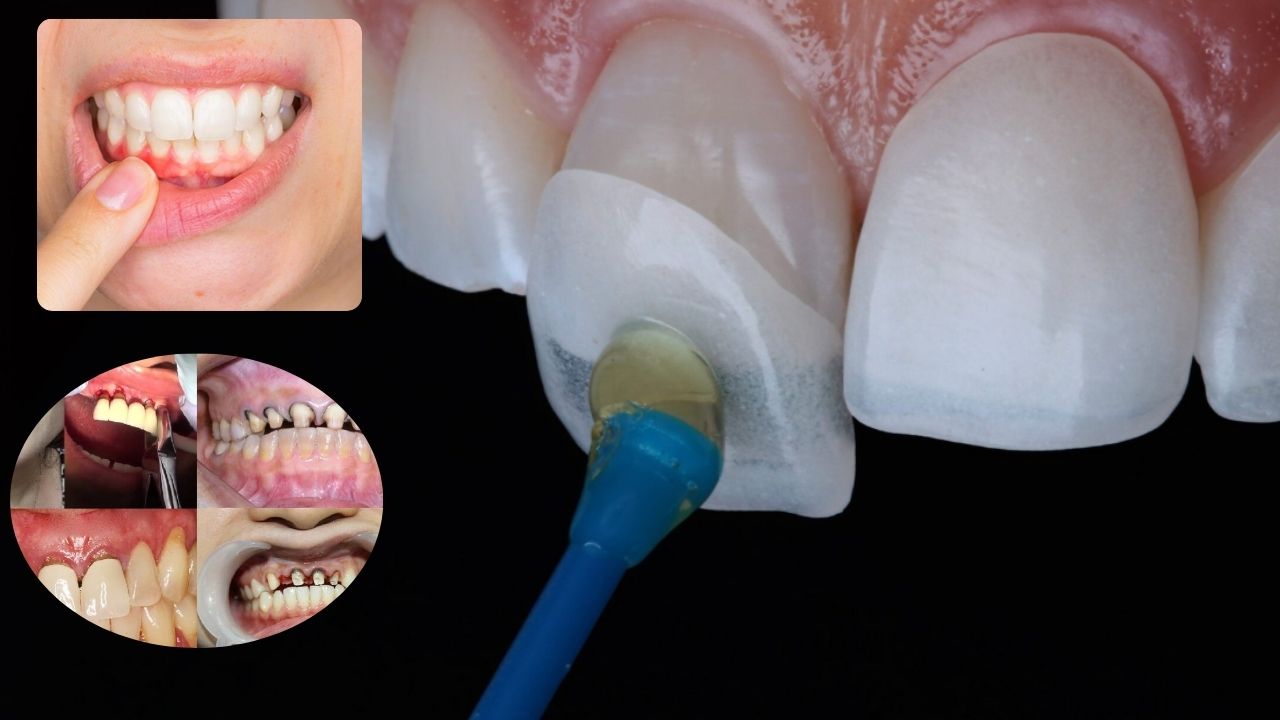 7 tác hại của dán răng sứ: Đừng làm nếu chưa đọc bài này!