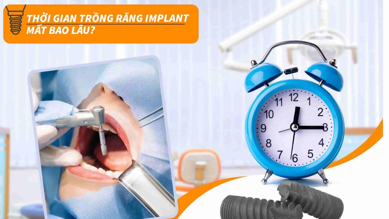 Thời gian trồng răng Implant là bao lâu? Các yếu tố ảnh hưởng