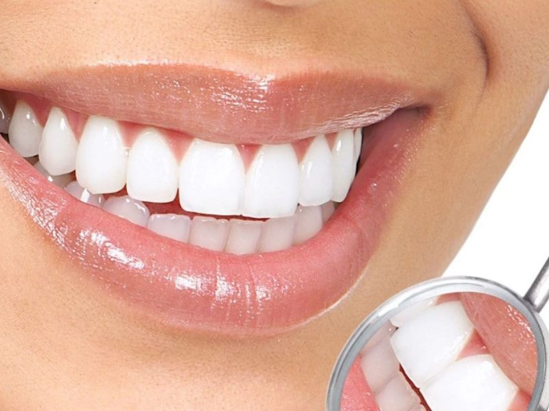 Thời gian trồng răng sứ thường mất từ 2–3 ngày, có thể lâu hơn đến 1 tuần