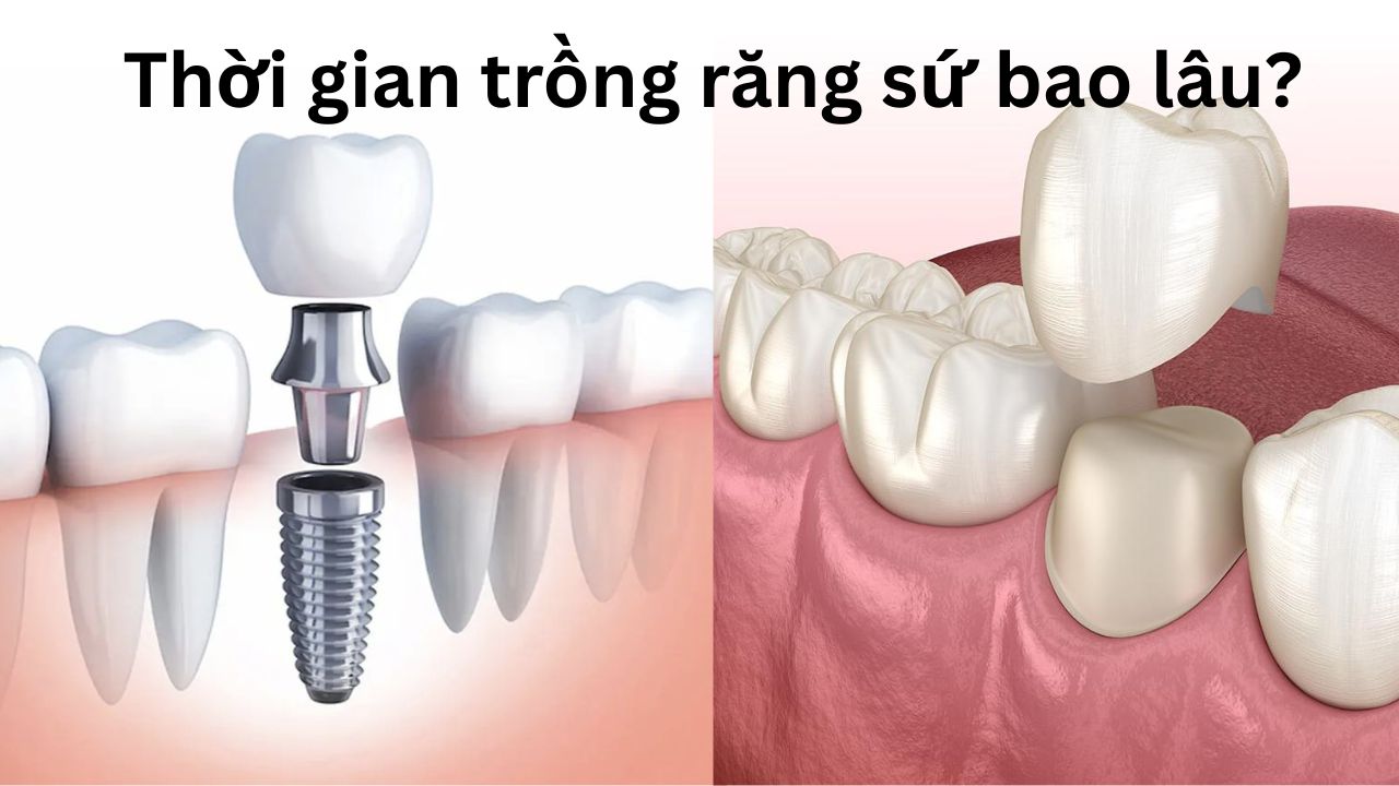 Thời gian trồng răng sứ mất bao lâu? cần lưu ý điều gì