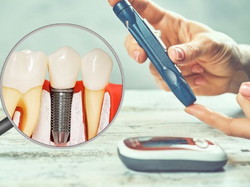 Người tiểu đường có thể cấy Implant nếu chỉ số đường huyết HbA1c < 7.5%.