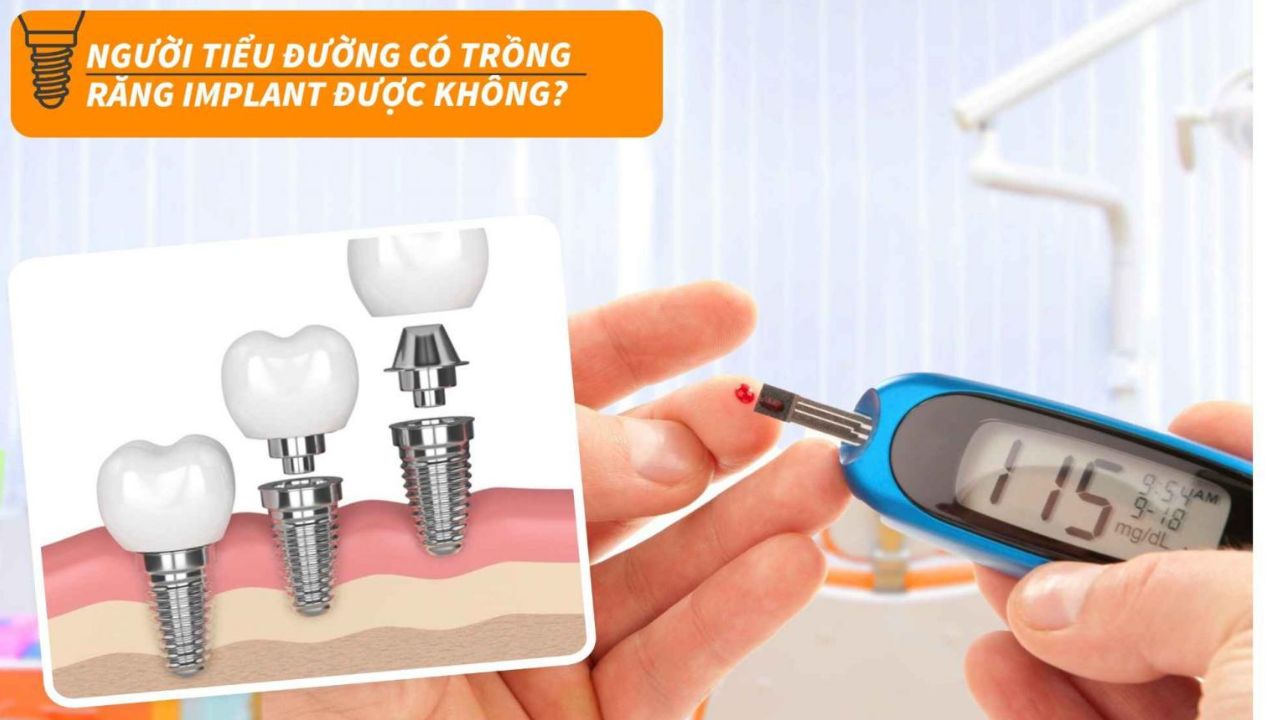 Tiểu đường có trồng răng implant được không? cần lưu ý điều gì