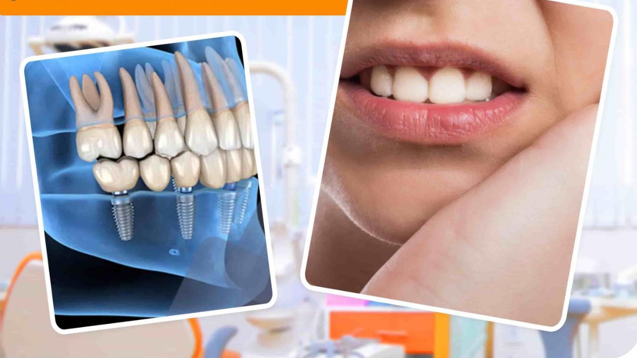 Trồng răng có đau không? Có cần nghỉ dưỡng không?