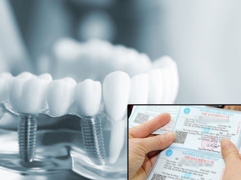 Trồng răng không được hưởng bảo hiểm y tế 