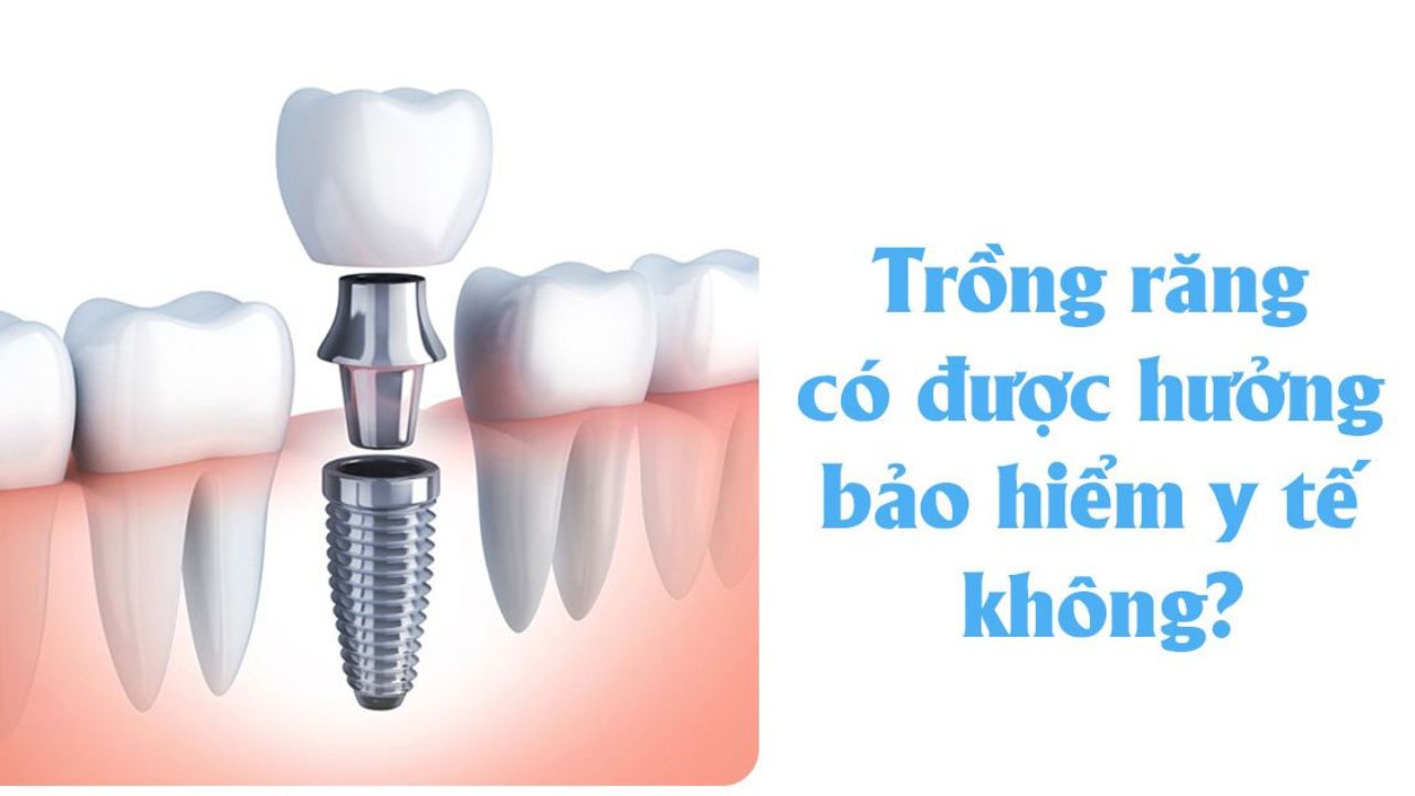 Trồng răng có được hưởng bảo hiểm y tế không? cần lưu ý điều gì