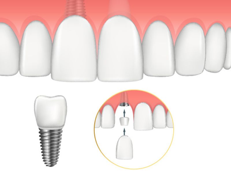 Trồng răng cửa dao động từ 1.500.000 triệu đến 35.000 triệu đồng/răng, tùy thuộc vào chất liệu răng sứ và phương pháp trồng răng.