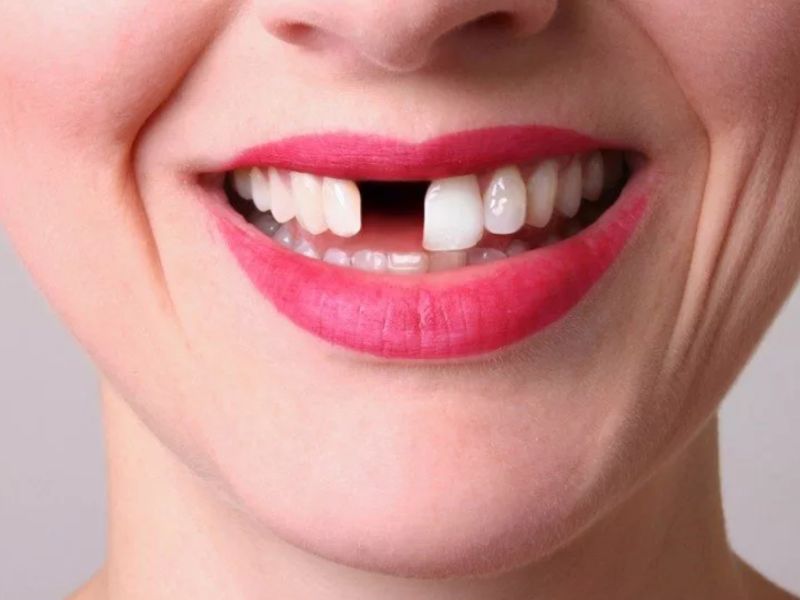 Trồng răng cửa có được bảo hành với nhiều loại vật liệu sứ và trụ Implant chất lượng cao