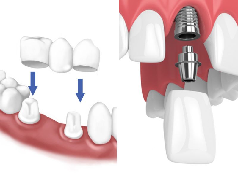 Các phương pháp trồng răng cửa hàm trên