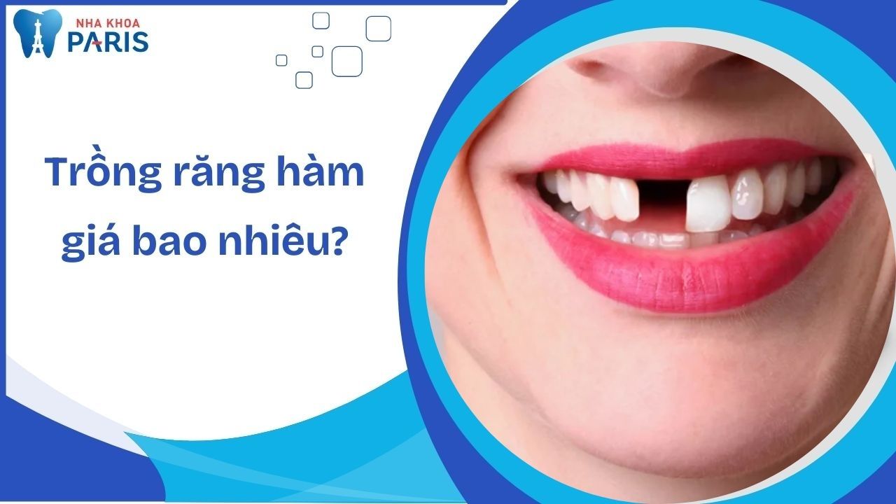 Trồng răng cửa hàm trên giá bao nhiêu? Bảng giá chi tiết