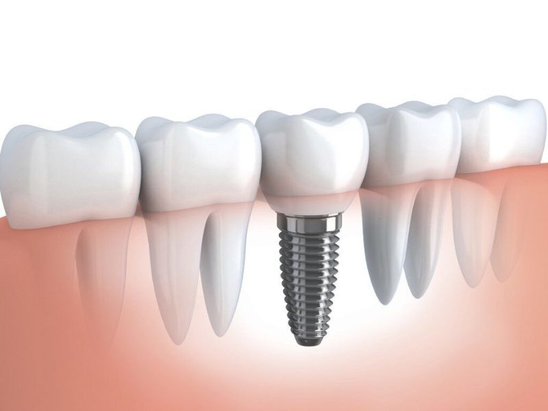Cấy ghép Implant giúp phục hồi hoàn hảo chức năng ăn nhai, phát âm và mang lại tính thẩm mỹ tự nhiên cao.
