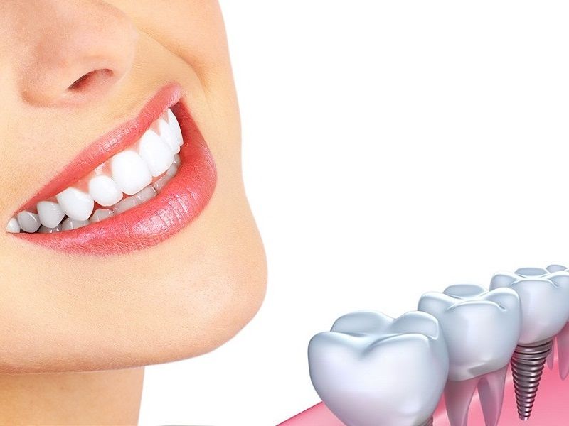 Cấy ghép Implant - phương pháp trồng răng giả tốt nhất hiện nay