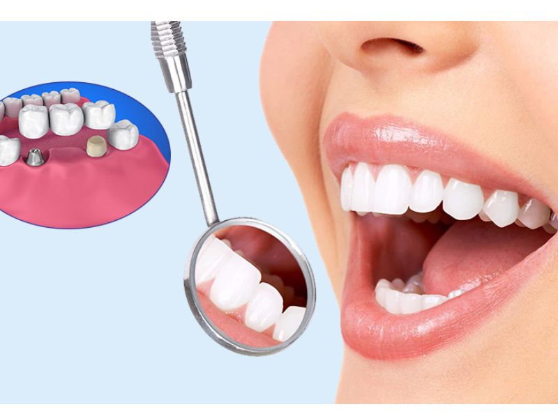 Trồng răng sứ giúp cải thiện thẩm mỹ khuôn mặt và nụ cười.
