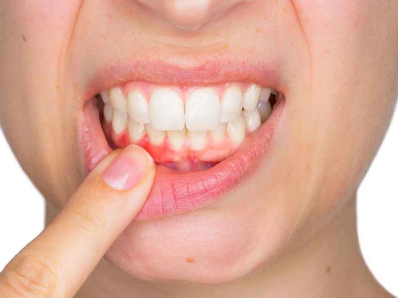 Trồng răng sứ không đúng, ảnh hưởng sức khỏe