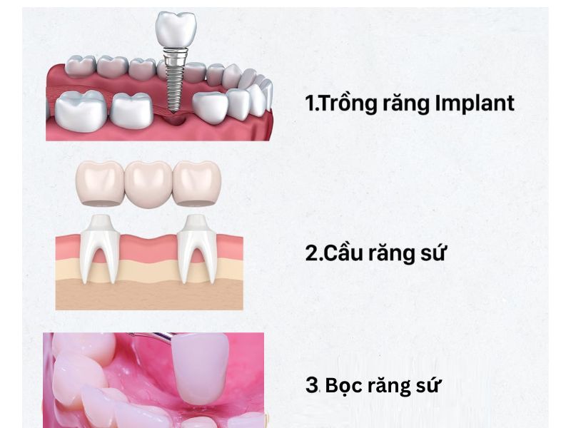 Các phương pháp trồng răng hiện nay