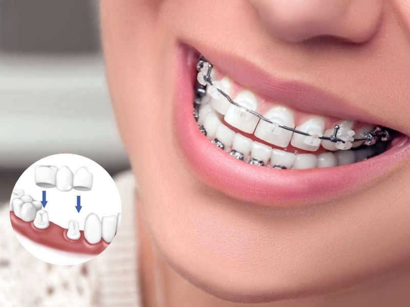 Trồng răng sứ rồi vẫn có thể niềng răng được
