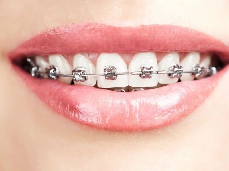 Ưu tiên niềng răng trước, trồng sứ sau