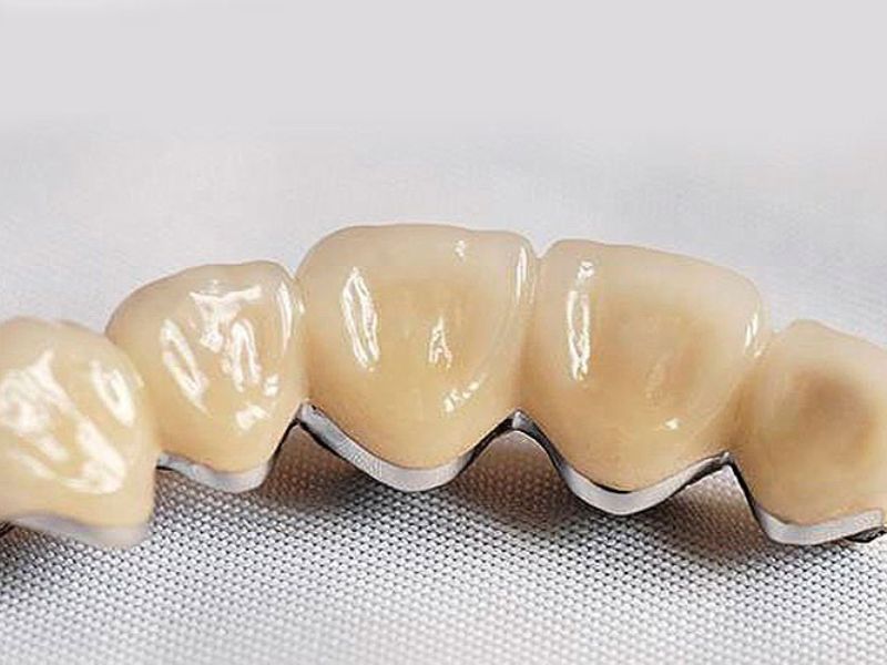 Trồng răng Titan là hình thức phục hình răng sử dụng mão răng sứ có lõi kim loại Titanium bên trong và lớp sứ phủ ngoài.