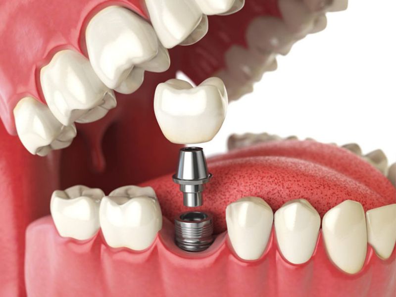 Ưu - nhược điểm trồng răng Titan