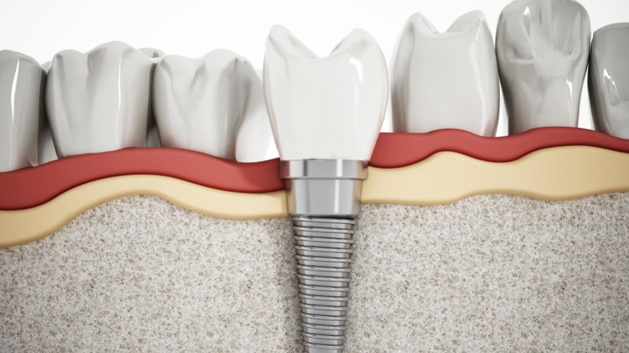 Trồng răng Titan là gì? ưu điểm là gì? cần chú ý điều gì