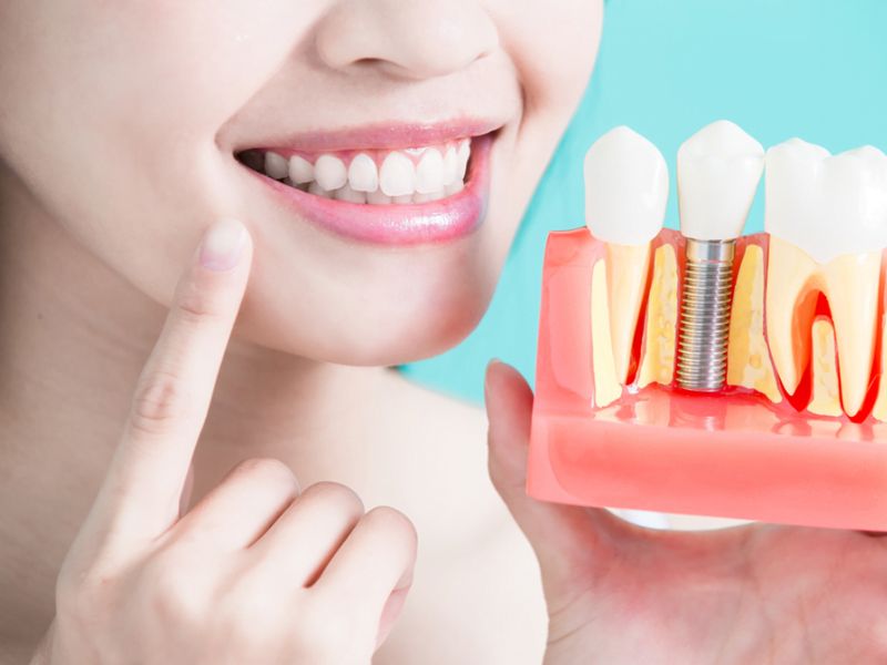 Độ tuổi thích hợp để trồng răng là từ 18 tuổi trở lên