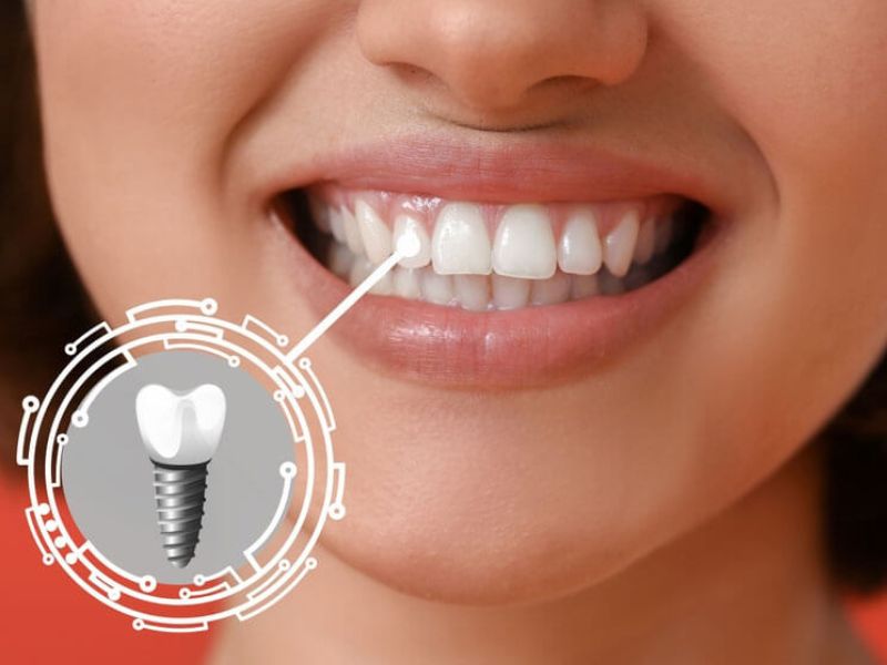 Cần đợi xương hàm phát triển và ổn định mới trồng răng được
