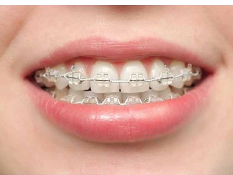 Niềng răng móm sớm giúp cải thiện chức năng ăn nhai, chỉnh khớp cắn hiệu quả