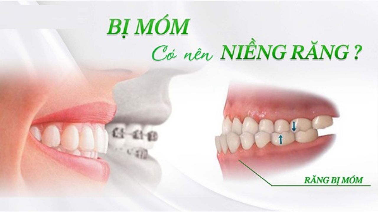 Bị móm có niềng răng được không? cần chú ý điều gì