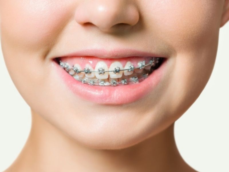 Niềng răng mắc cài kim loại truyền thống – hiệu quả, chi phí thấp