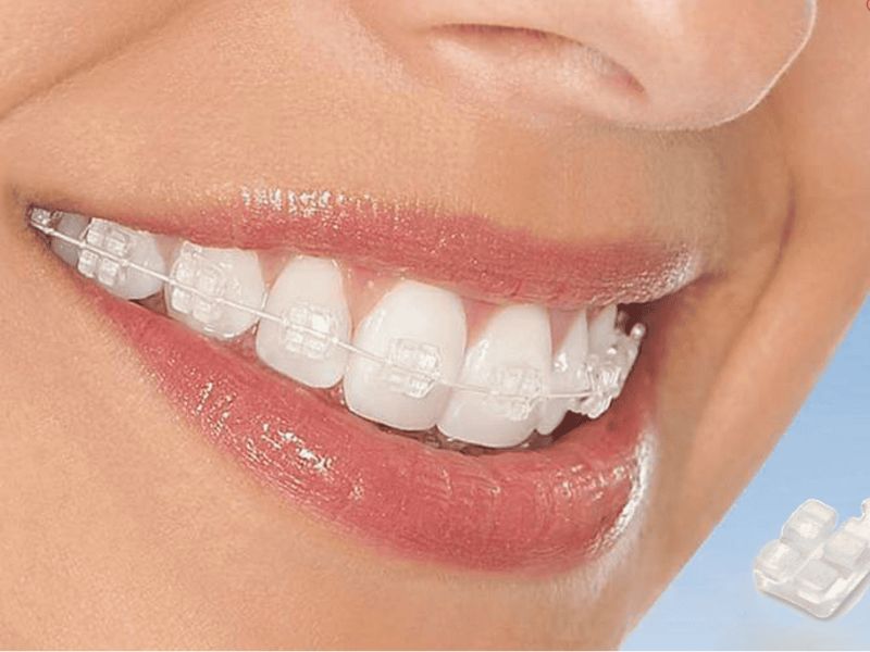 Niềng răng mắc cài sứ thẩm mỹ – phù hợp với người làm công việc giao tiếp
