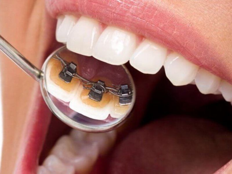 Niềng răng mặt lưỡi giúp chỉnh nha kín đáo, không lộ mắc cài