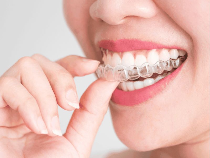 Niềng răng không mắc cài Invisalign – lựa chọn hiện đại và tiện lợi