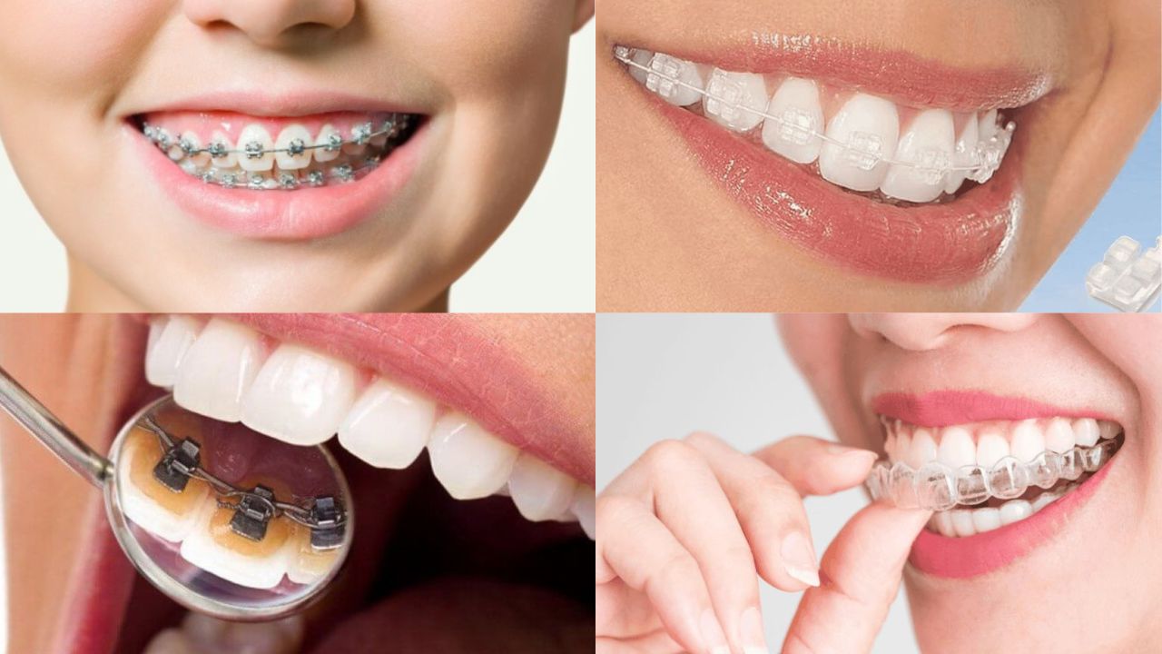 4 kiểu niềng răng phổ biến hiện nay trên thị trường
